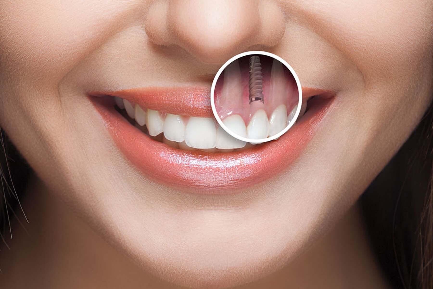 Trồng răng Implant mất bao lâu? Có cần nghỉ làm không?